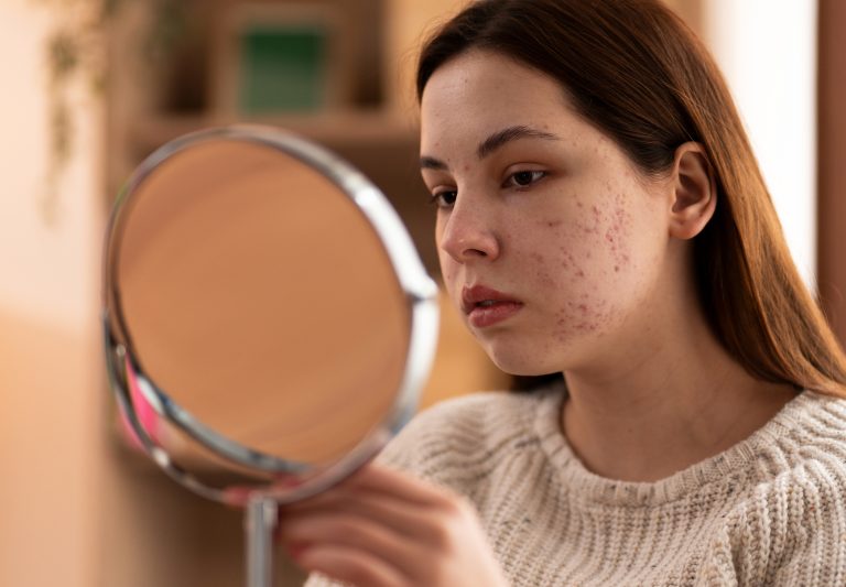 hormonal acne